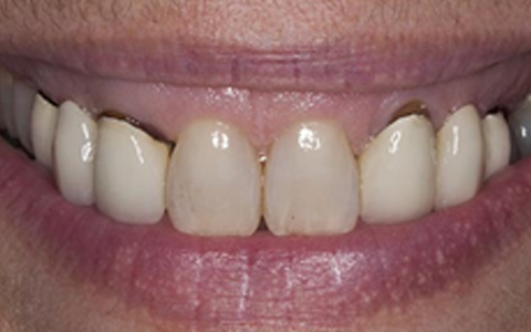 Metal free zirconia crowns