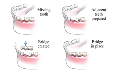 Traditional Dental Bridges