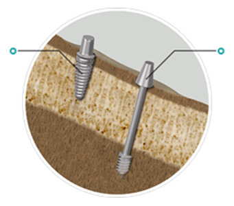 Immediate Loading in Implant Engaging Basal Bone