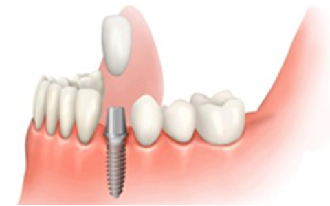 Single Piece Implants