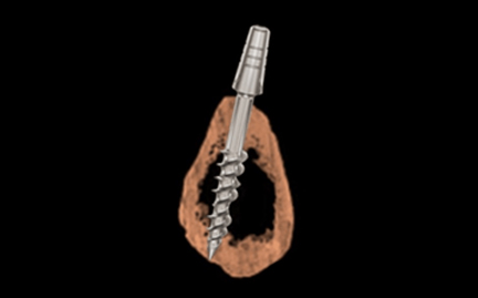 Basal Implants - Immediate Loading