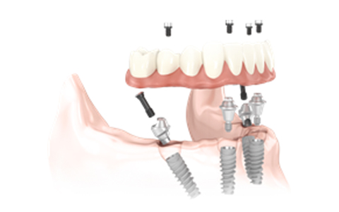 Components of Full Arch Bridge