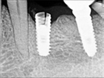 Flowering/Fracture of multi unit implants