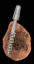 Immediate loading dental implant technique