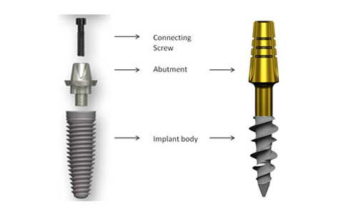 difference between basal and crestal implants