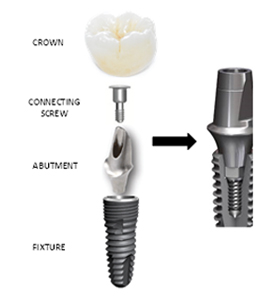 Multi-unit implant system