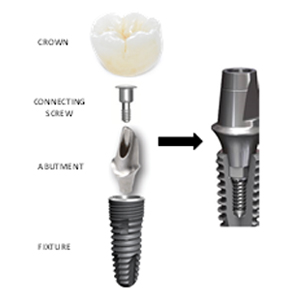 Difference between basal and crestal implants