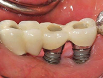  Exposed Rough Surface of multi unit implant