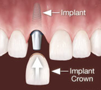 Difference between basal and crestal implants