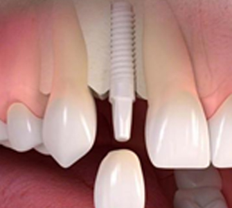 Zirconia Implant