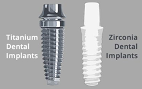 Zirconia vs. Titanium Implants