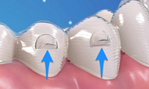 Attachment on the teeth