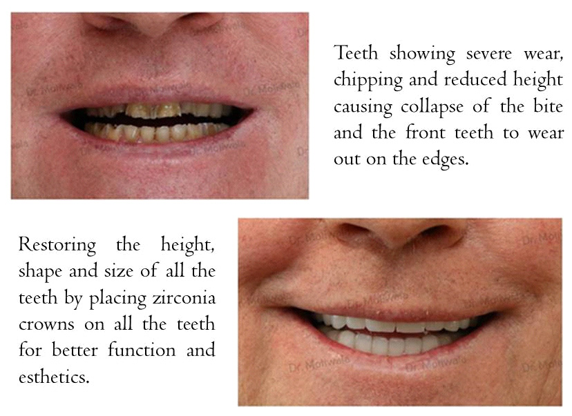 Before and after smile makeover with bite raise