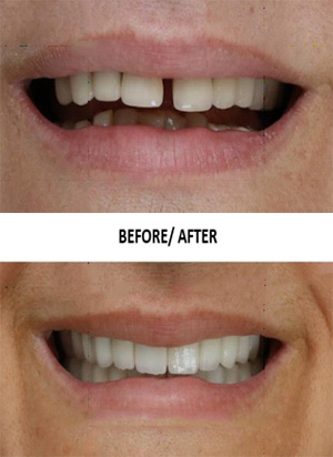 Before and after smile makeover