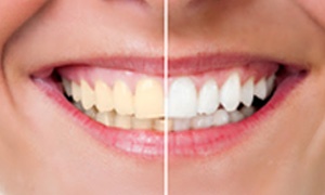 Before and after teeth whitening