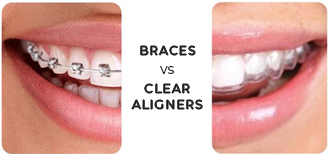 Braces Vs Clear Aligners