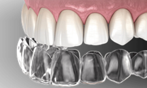 Clear Aligners