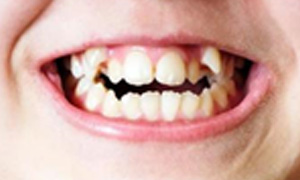 Crowded or Crooked Teeth