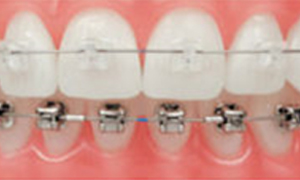 Damon Ceramic Brackets