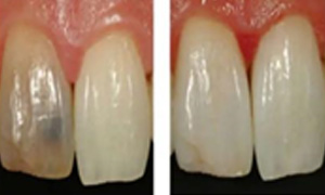 Discoloration of non-vital tooth