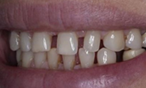 Gaps between the teeth