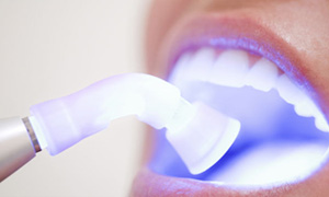 Laser teeth whitening