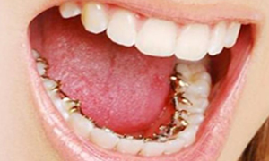 Lingual Braces