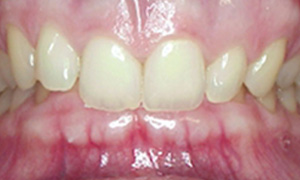 Over-Bite (Deep Bite)