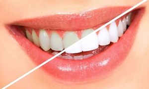 Teeth bleaching