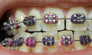 Traditional Braces