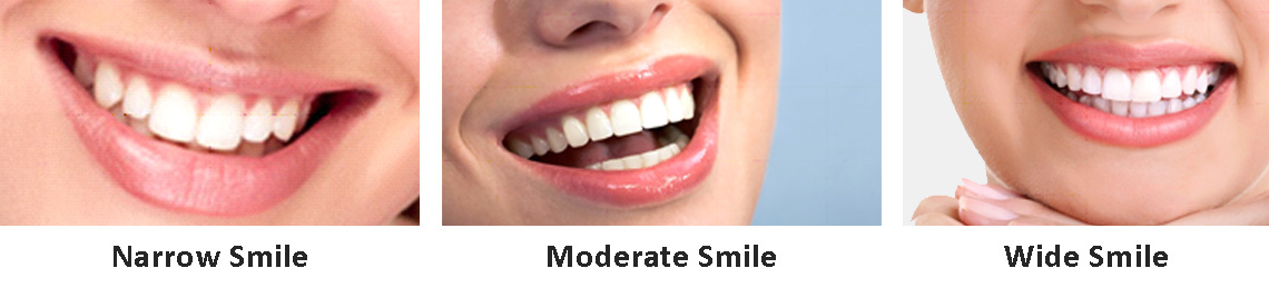 Types of complete smile dental in india