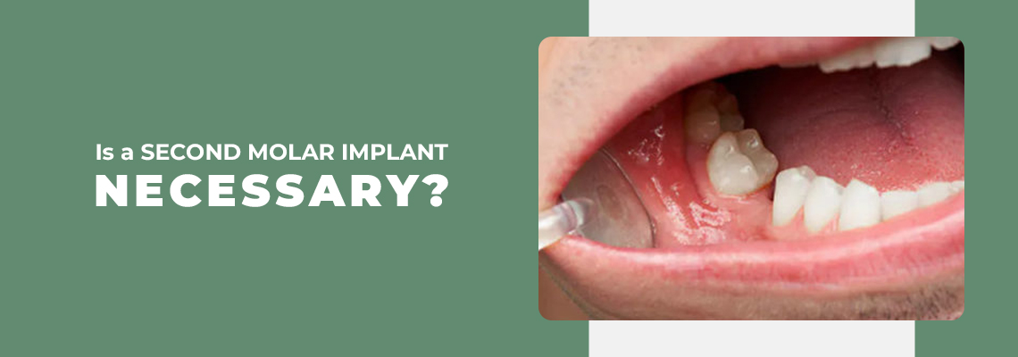 Is second molar implant necessary?