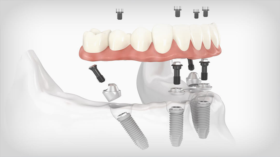 Same Day Dental Implants