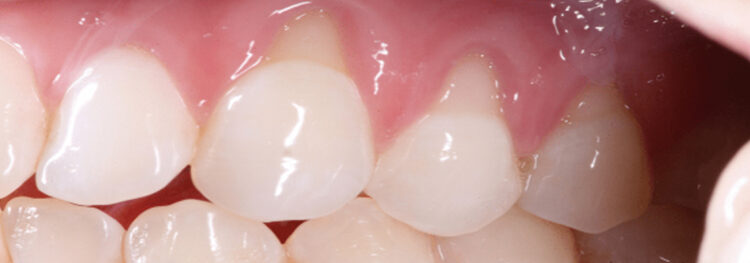 Can receding gums grow back?