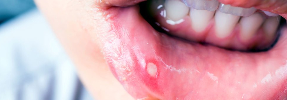 Read more about the article Conquering Canker Sores