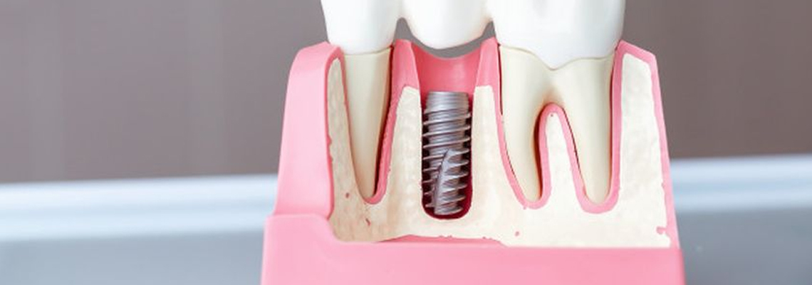 How Do I Take Care of My Dental Implants?