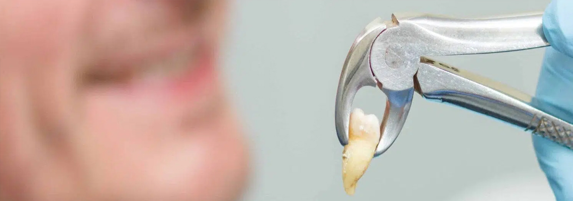 Read more about the article What to Eat Post Extractions?