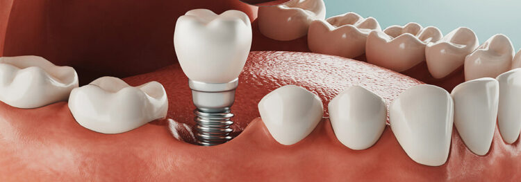 An Overview of Dental Implant Procedure Steps
