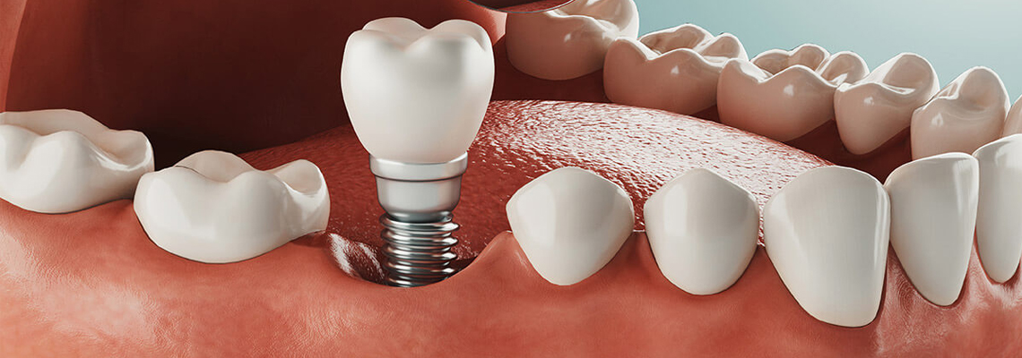 Read more about the article An Overview of Dental Implant Procedure Steps