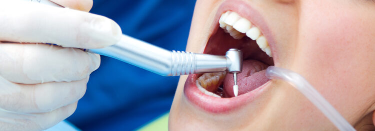Common Misconceptions About Root Canals