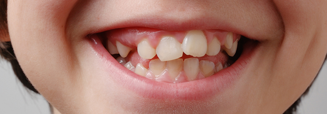 Read more about the article Causes of Crooked Teeth