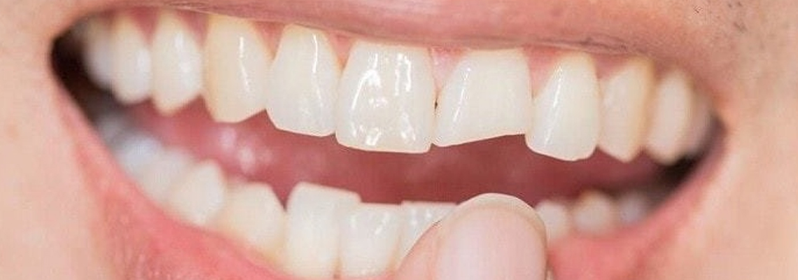 Read more about the article How to Fix a Chipped Tooth