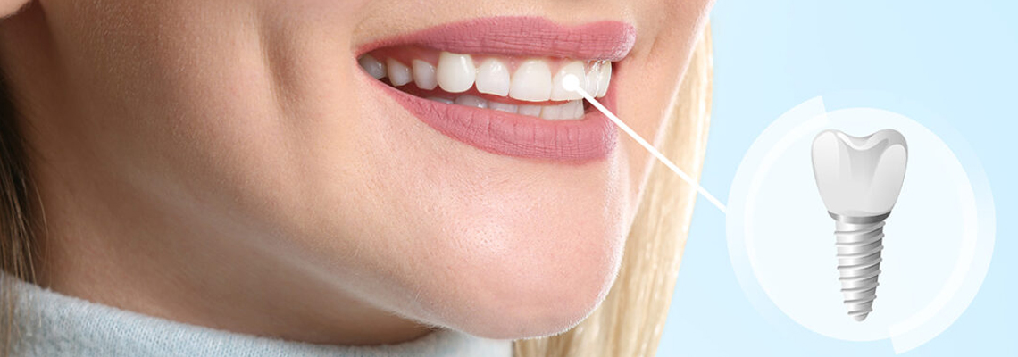 Read more about the article How to Have a Successful Dental Implant?