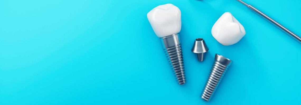 Read more about the article What is the Dental Implant Success Rate?