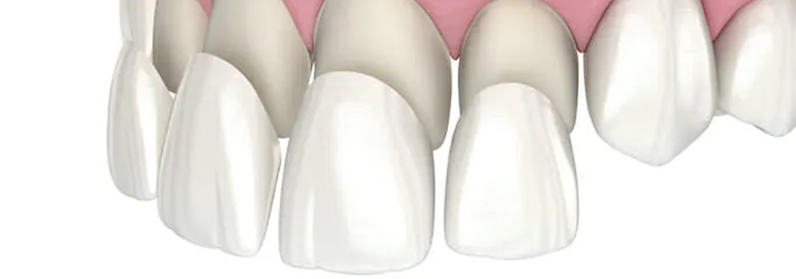 Read more about the article How To Prevent Stains on Dental Veneers?