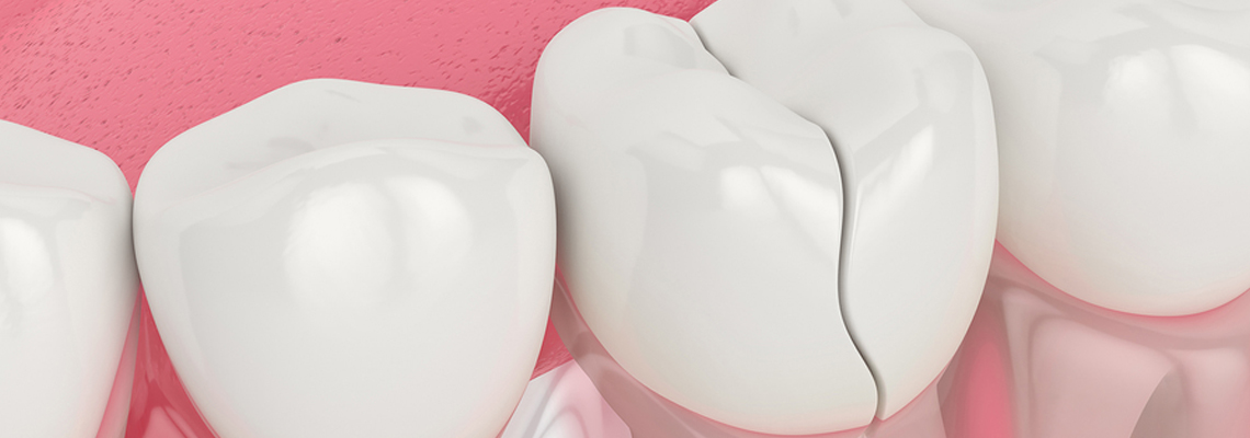 Read more about the article Why Are Cracked Teeth Cases Going Up?