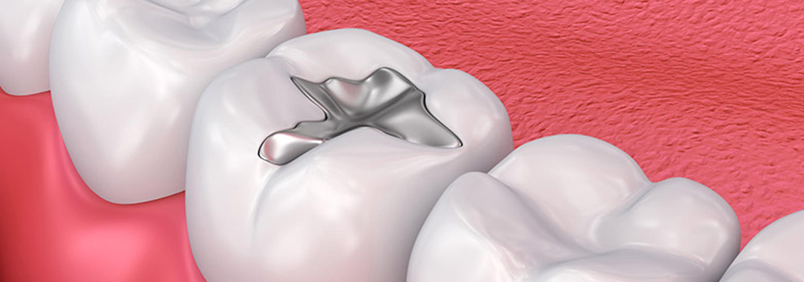 Read more about the article How Long Do Dental Fillings Last?