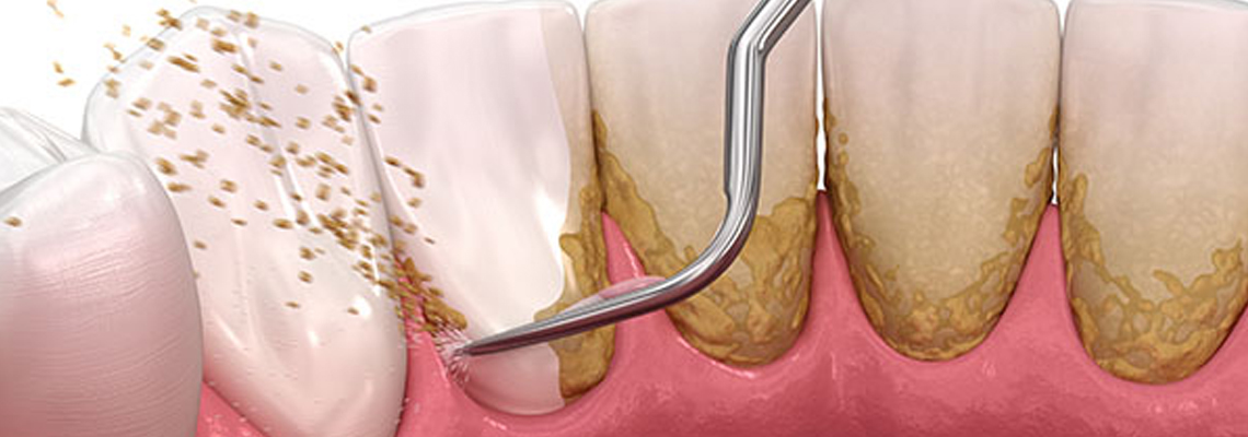Read more about the article The Root Of Many Dental Evils – Tartar