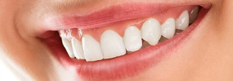 How Dental Bridges Can Restore A Healthy Smile?