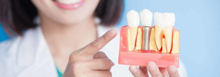 Dental Implants: Tips for Long-Term Success